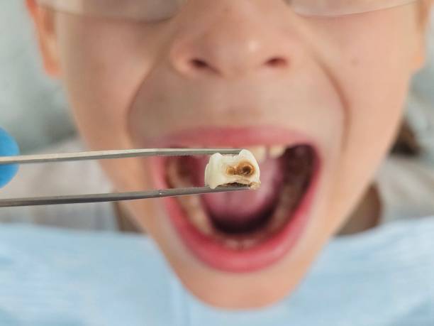 Best Urgent Dental Care for Toothache in Woodstock, VA